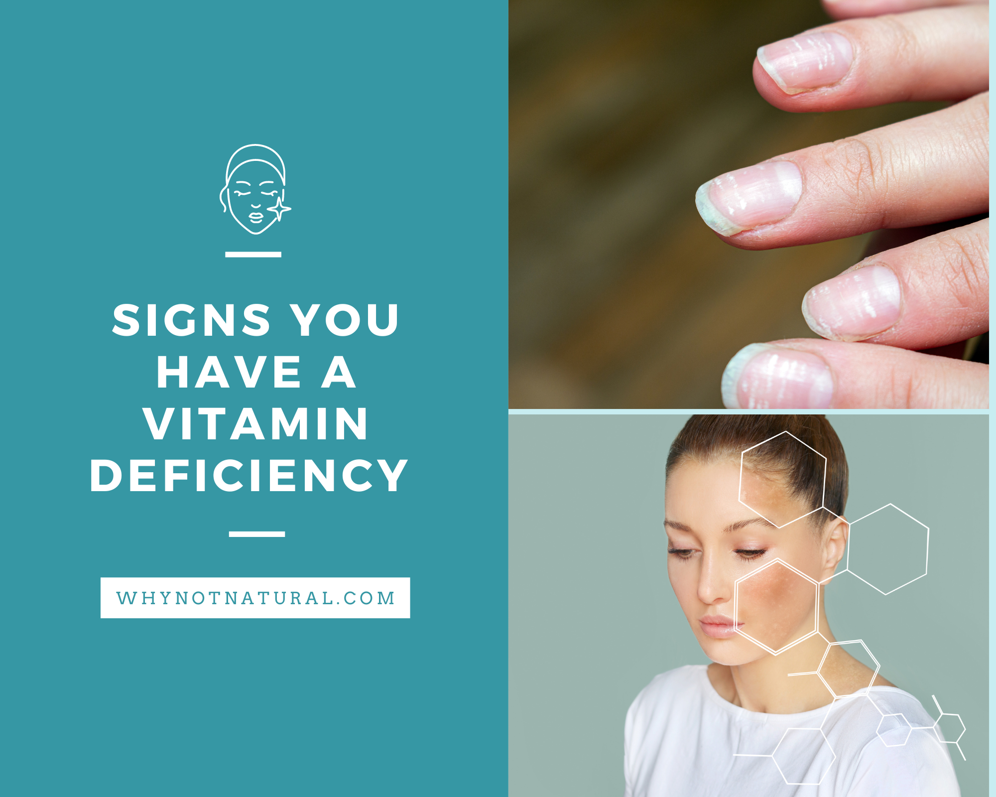 Signs you have a vitamin deficiency