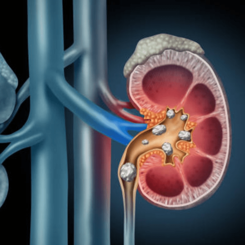 Can Vitamin D Cause Kidney Stones? Unveiling the Connection - WhyNotNatural